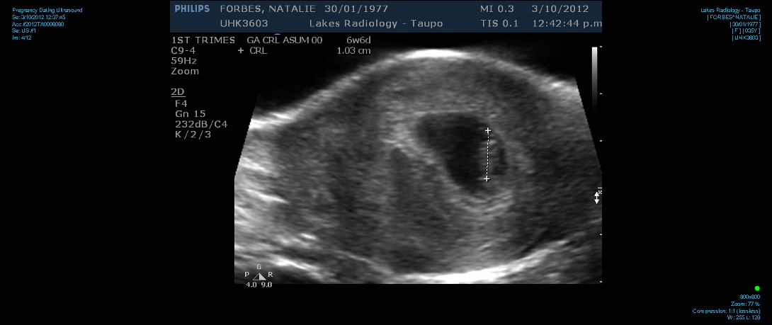accuracy ultrasound dating early pregnancy